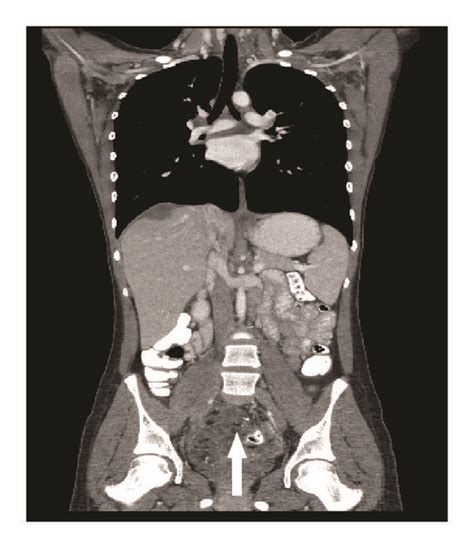 Computed Tomography Abdomen And Pelvis Follow Up Imaging At 8 Months