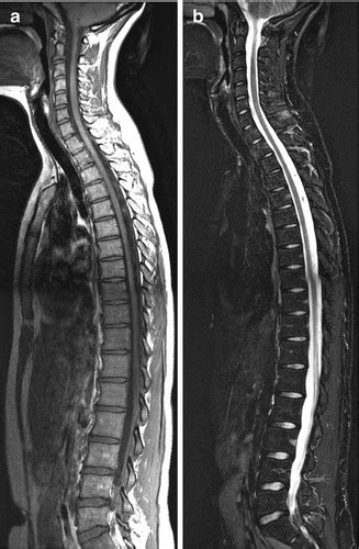 Spondyloarthropathy | Radiology Key