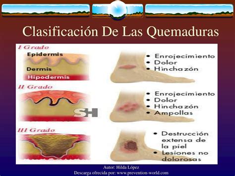 Clasificacion De Las Quemaduras