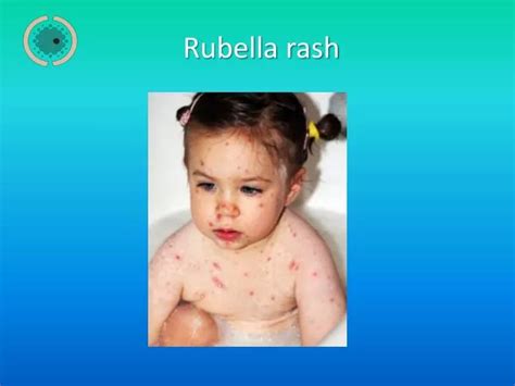 PPT - Rubella rash PowerPoint Presentation, free download - ID:6712774