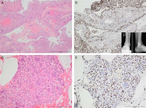 Photomicrographs A And B And Radiographs C Of A GCTB With Extensive