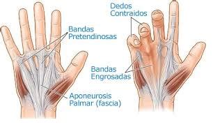 LA ENFERMEDAD DE DUPUYTREN Blog Clínica Privada Jaime I Catarroja en