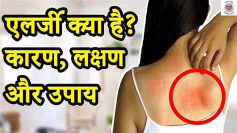 एलर्जी क्या है एलर्जी के लक्षण और उपचार What Is Allergy Symptoms And Treatment Of Allergy