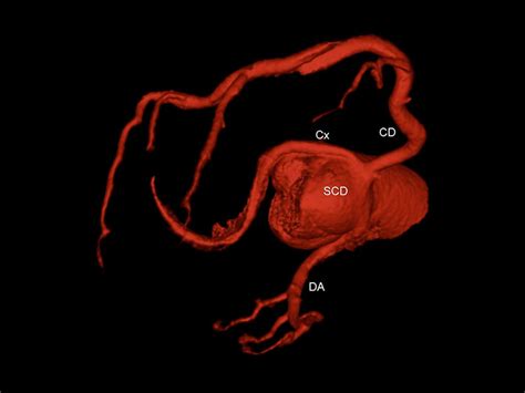 Angiotomografia das Artérias Coronárias Imagem