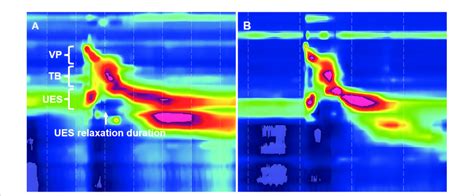 Time Space Chart Of High Resolution Manometry In A Tracheostomized