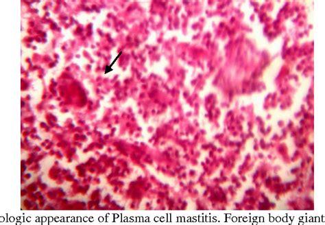 Figure 1 From Plasma Cell Mastitis Mimicking As Carcinoma Of The Breast