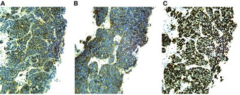 Frontiers Dual Paraneoplastic Endocrine Syndromes Heralding Onset Of Extrapulmonary Small Cell