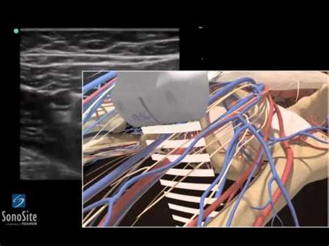3D Comment Bloc Nerf Saphène échoguidé échographe SonoSite YouTube