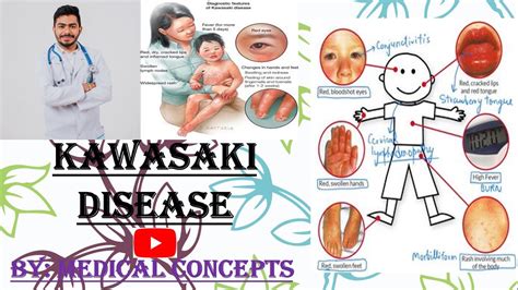 Kawasaki Disease Symptoms Diagnosis Treatment Youtube