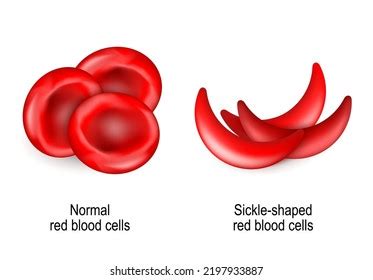 Sickle Cell Disease Scd Blood Disorder Stock Vector Royalty Free