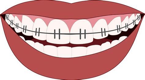 Download Orthodontics, Smile, Teeth. Royalty-Free Vector Graphic - Pixabay