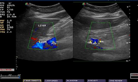 Common Hepatic Duct Ultrasound