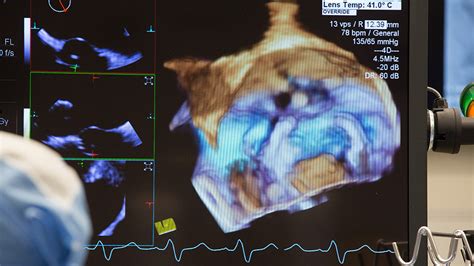 Diagnosing Mitral Valve Disease Nyu Langone Health