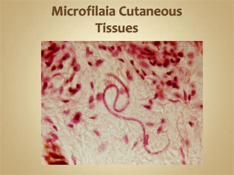 Ppt Onchocerciasis Powerpoint Presentation Free Download Id1946841