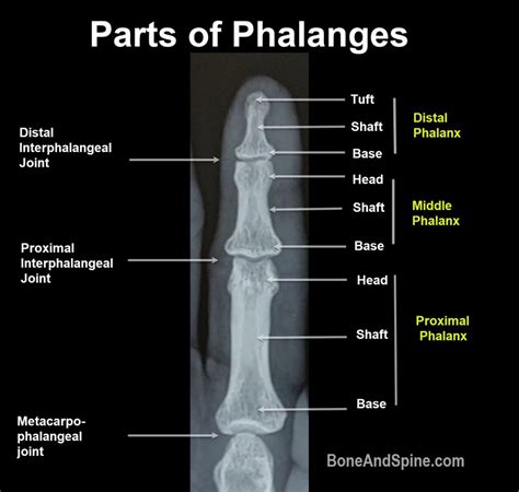 Distal Phalanx Shaft Fracture - Rxharun