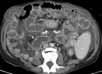 Bowel Obstruction Ct Scan