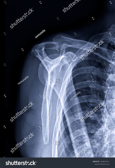 Radiographic Image Xray Image Shoulder Joint库存照片1268274511 Shutterstock