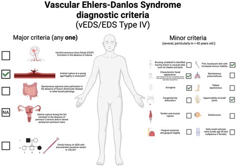 Vascular Ehlers Danlos Syndrome Diagnostic Criteria According With