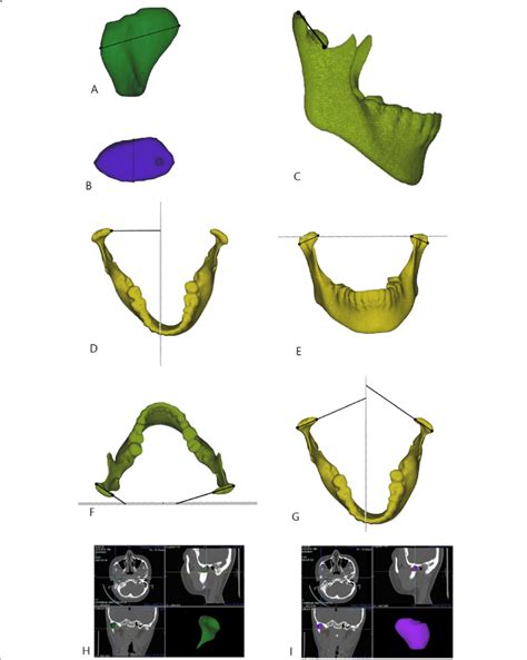 The Measurements Of The Mandibular Condyle A Mediolateral Dimension Of Download Scientific