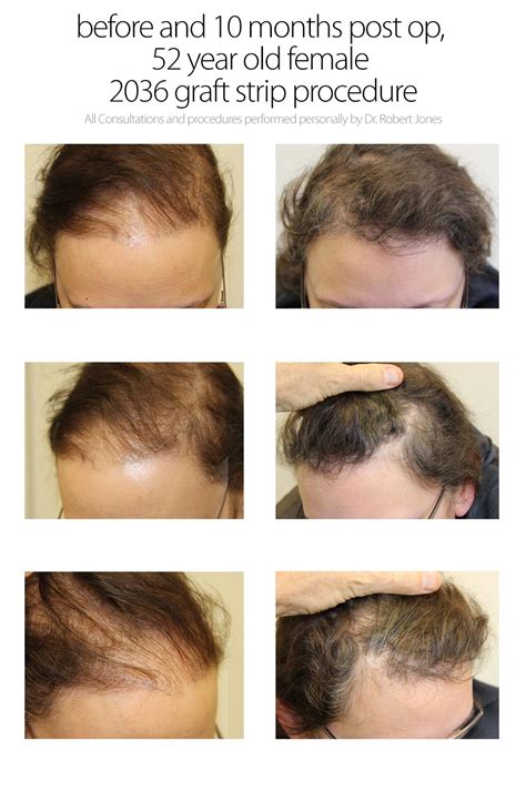 Hair Transplant Results Toronto Hair Transplant Surgeons