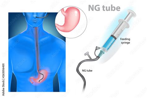 Nasogastric Intubation Nasogastric Tube Or Ng Tube Stock Adobe Stock