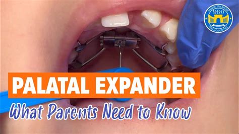 8 Things To Know About Palatal Expander Youtube