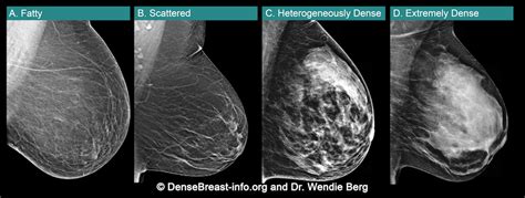 Breast Screening In The Uk Breast Density And Impacts On Health