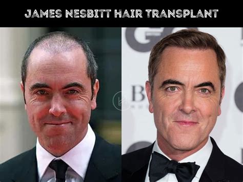 James Nesbitt Hair Transplant Hair Loss Technical Analysis