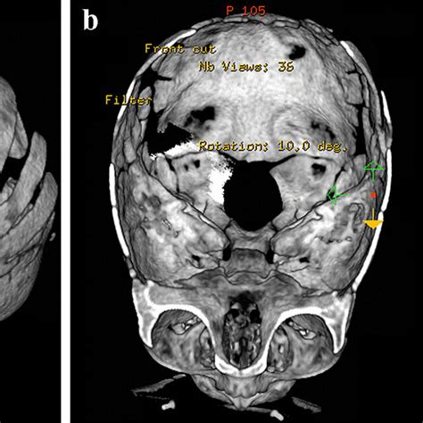 Postoperative Non Contrast Enhanced Cone Beam Computed Tomography