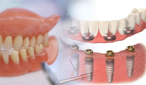 Permanent Dentures And Its Pros And Cons Preferrred Dental Care