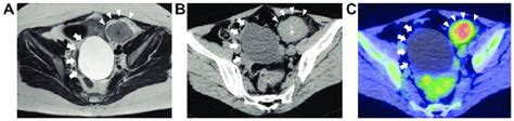 Radiological Findings Of Pelvic Retroperitoneal Castleman S Disease