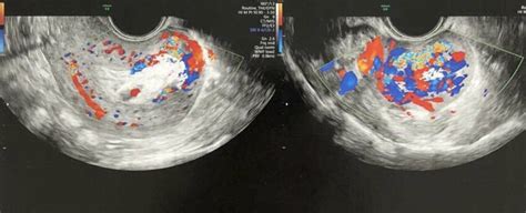 Transvaginal Color Doppler Ultrasound Image Showing Avm Download