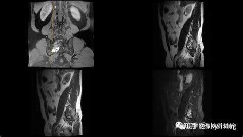 Mr平扫增强对骶椎良恶性肿瘤的鉴别诊断并一例骨巨细胞瘤合并动脉瘤样骨囊肿典型病例探讨、报告书写范例（全文） 知乎