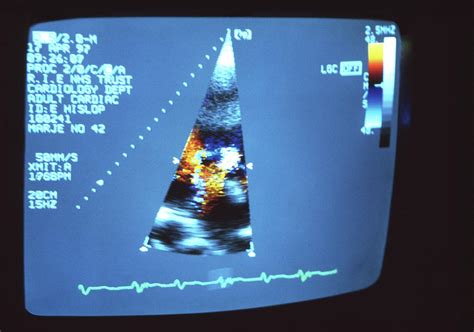 Heart Ultrasound Scan Photograph by Antonia Reeve/science Photo Library