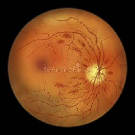 Diabetic Retinopathy Ophthalmoscopic Diagnosis Illustration Stock