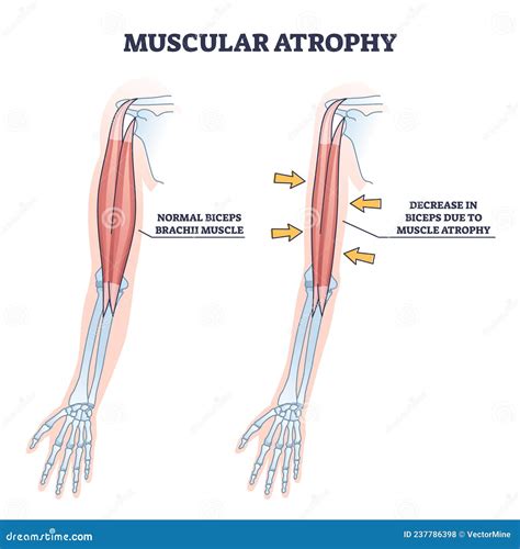 Atrophy Cartoons, Illustrations & Vector Stock Images - 1012 Pictures ...