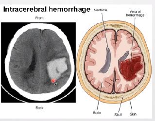 Cerebrovascular Accident CVA AKA Stroke Flashcards Quizlet