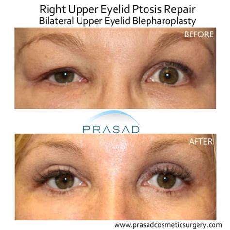 Can Upper Blepharoplasty Go Wrong Dr Prasad Blog