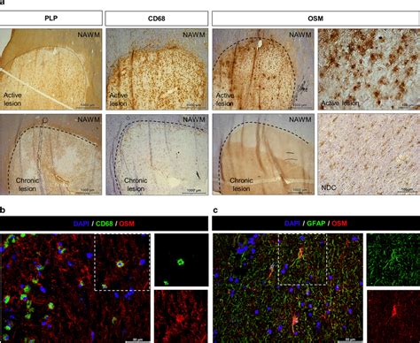 OSM Is Expressed By Activated Myeloid Cells And Astrocytes In Active MS