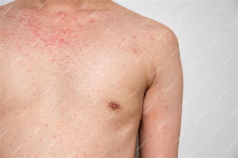 Premium Photo Dermatitis Rash Viral Disease With Immunodeficiency On