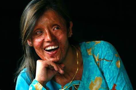 How To Help Acid Attack Victims Heal By Spreading Awareness And Acceptance