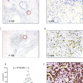 Immunohistochemical Staining Of IgG4 In UT A B And NP C D With