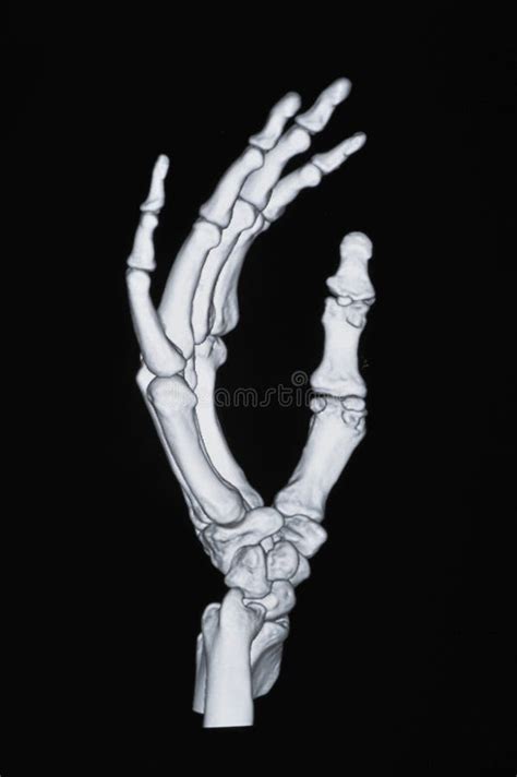 X-ray of hand stock image. Image of radiology, fingers - 309579961