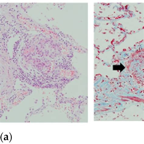 Autopsy Of Poph Patient 1 Hematoxylin Eosin Stain A And Masson Download Scientific Diagram