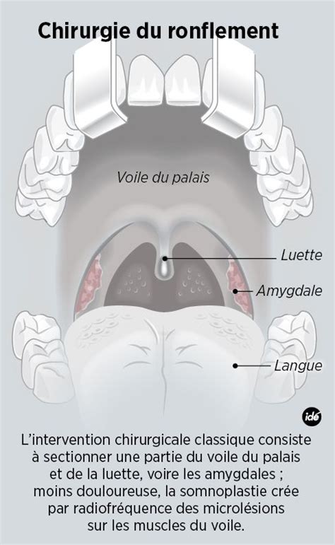 Sciences Avenir Dossier H Pitaux Chirurgie Du Ronflement