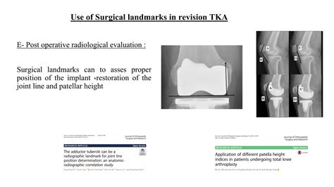 Surgical Landmarks In Revision Total Knee Ppt