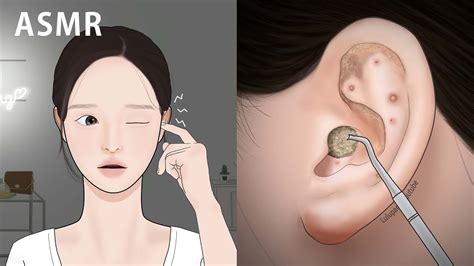 Asmr 대왕귀지 귀청소 여드름 압출 Ear Cleaning Animation Youtube