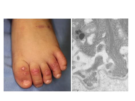 Junctional And Dystrophic Epidermolysis Bullosa Intechopen