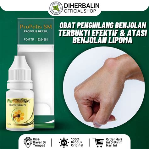 Jual ProPolis SM Obat Benjolan Di Tangan Kista Ganglion Benjolan