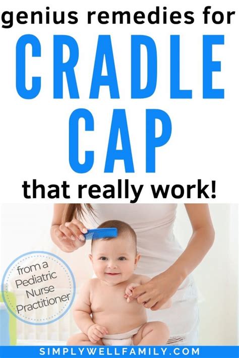 Simple Info About How To Get Rid Of Cradle Cap In Infants